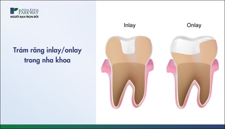 Trám răng inlay, onlay trong nha khoa