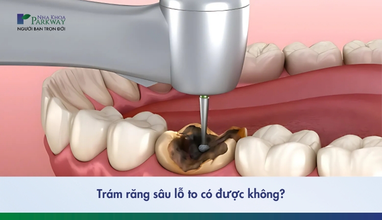 trám răng sâu lỗ to - 1