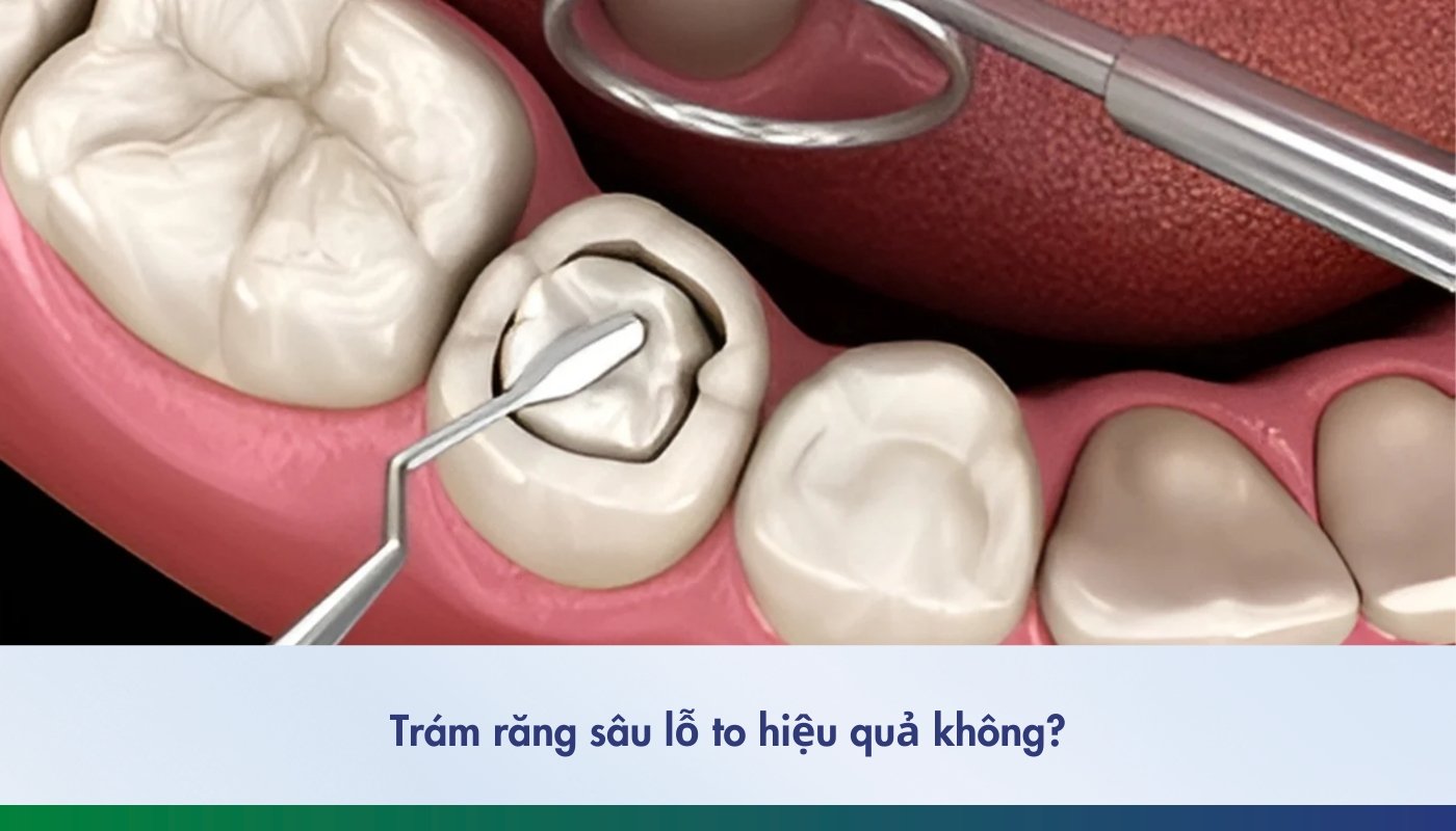 trám răng sâu lỗ to - 2