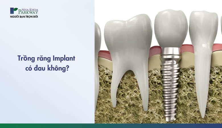 trồng răng implant có đau không