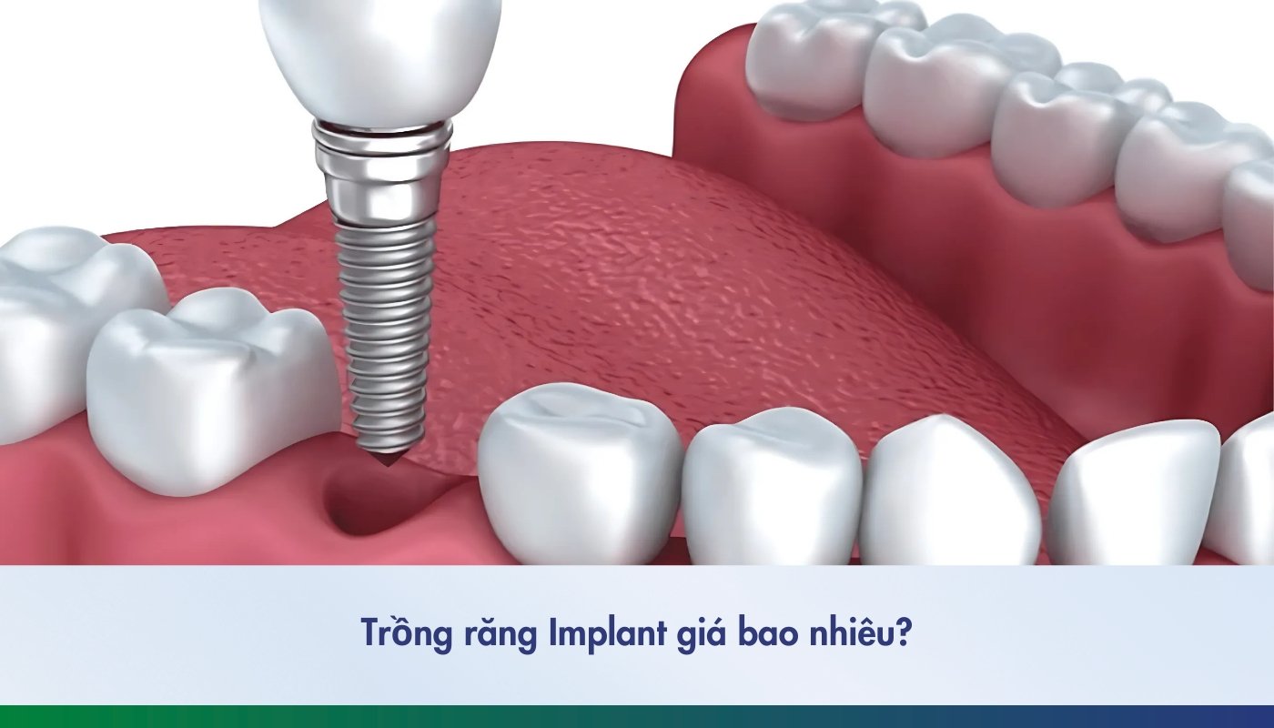 trồng răng implant giá bao nhiêu - 1