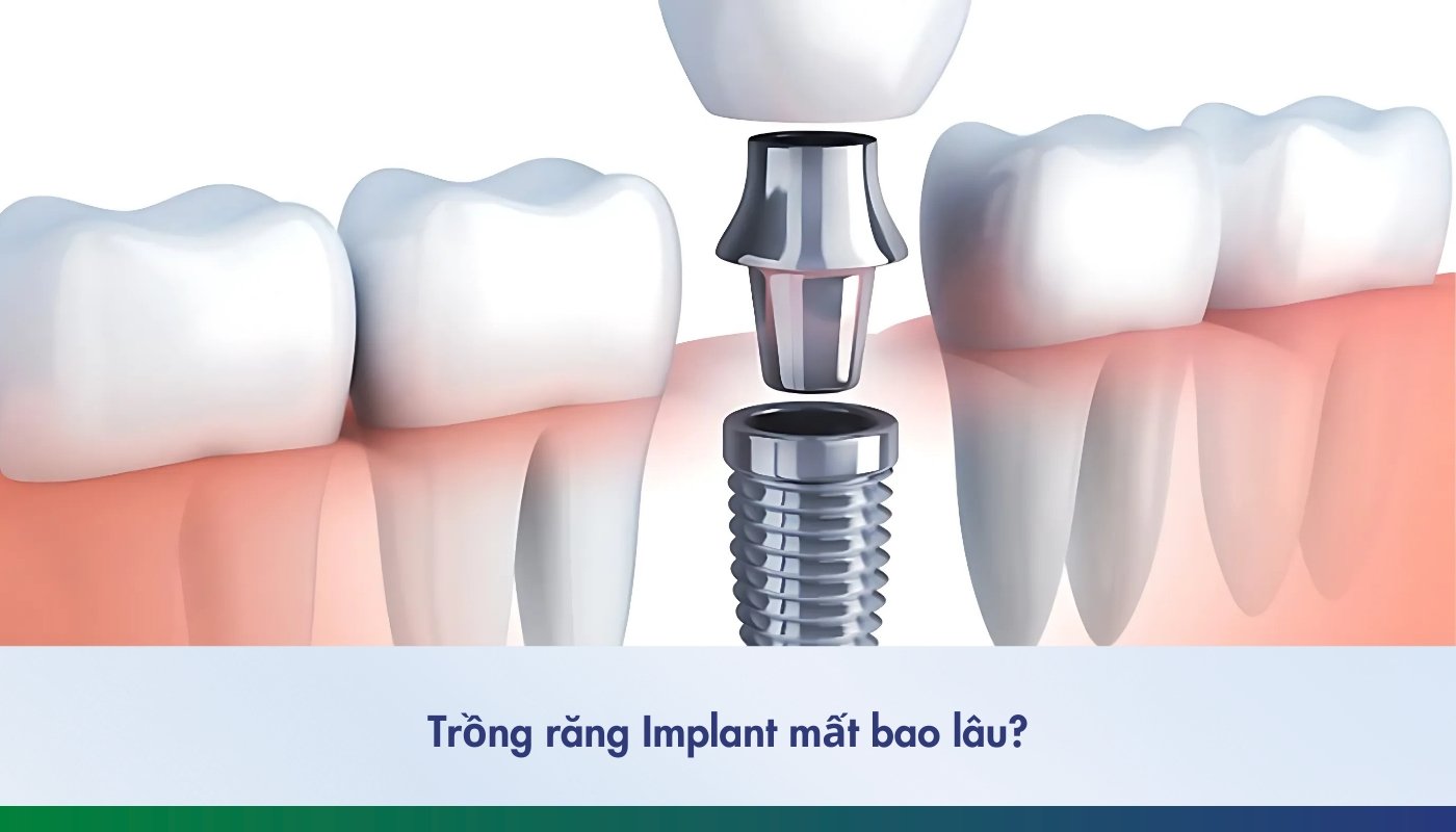 trồng răng implant mất bao lâu 2