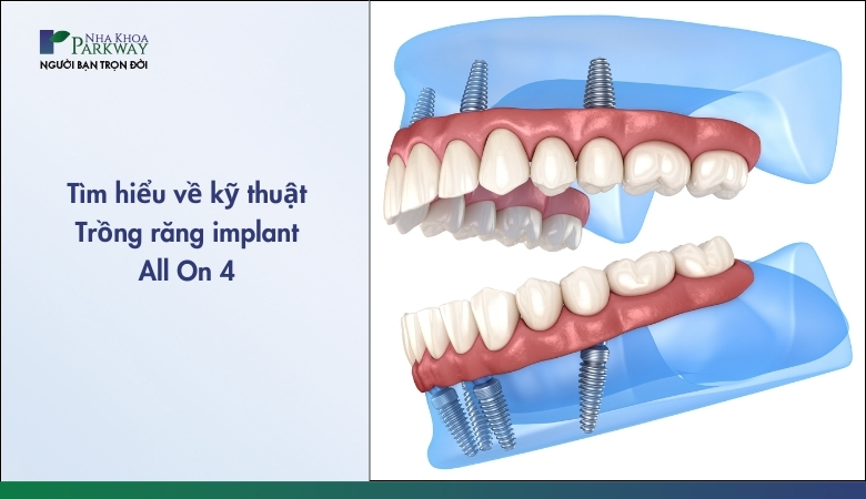 Trồng răng Implant All On 4 - 1