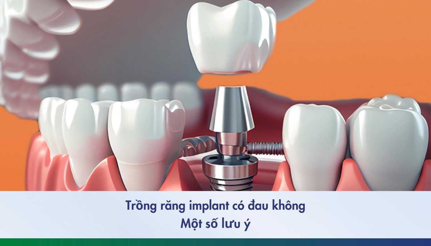 trồng răng implant có đau không - 2