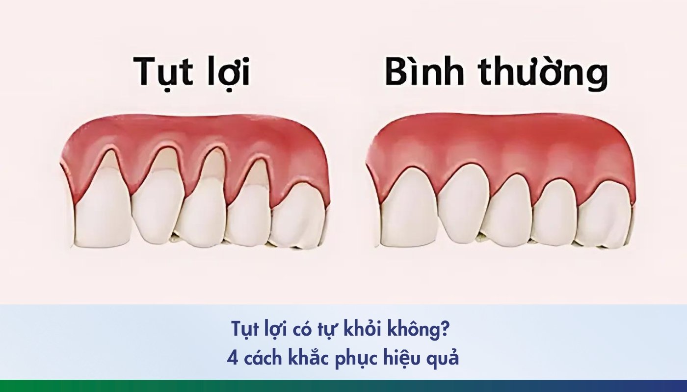 tụt lợi và cách khắc phục