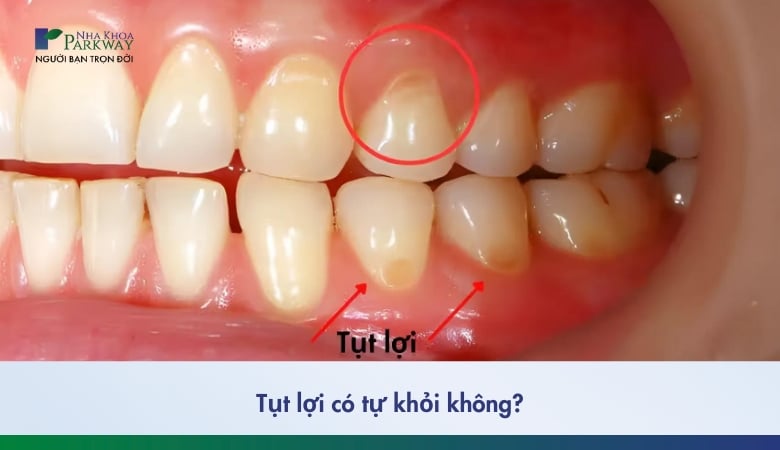 tụt lợi có tự khỏi không