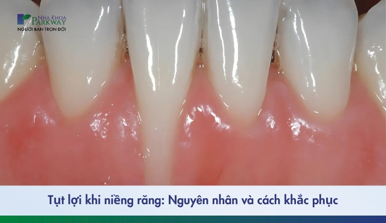 Hình ảnh tụt lợi khi niềng răng