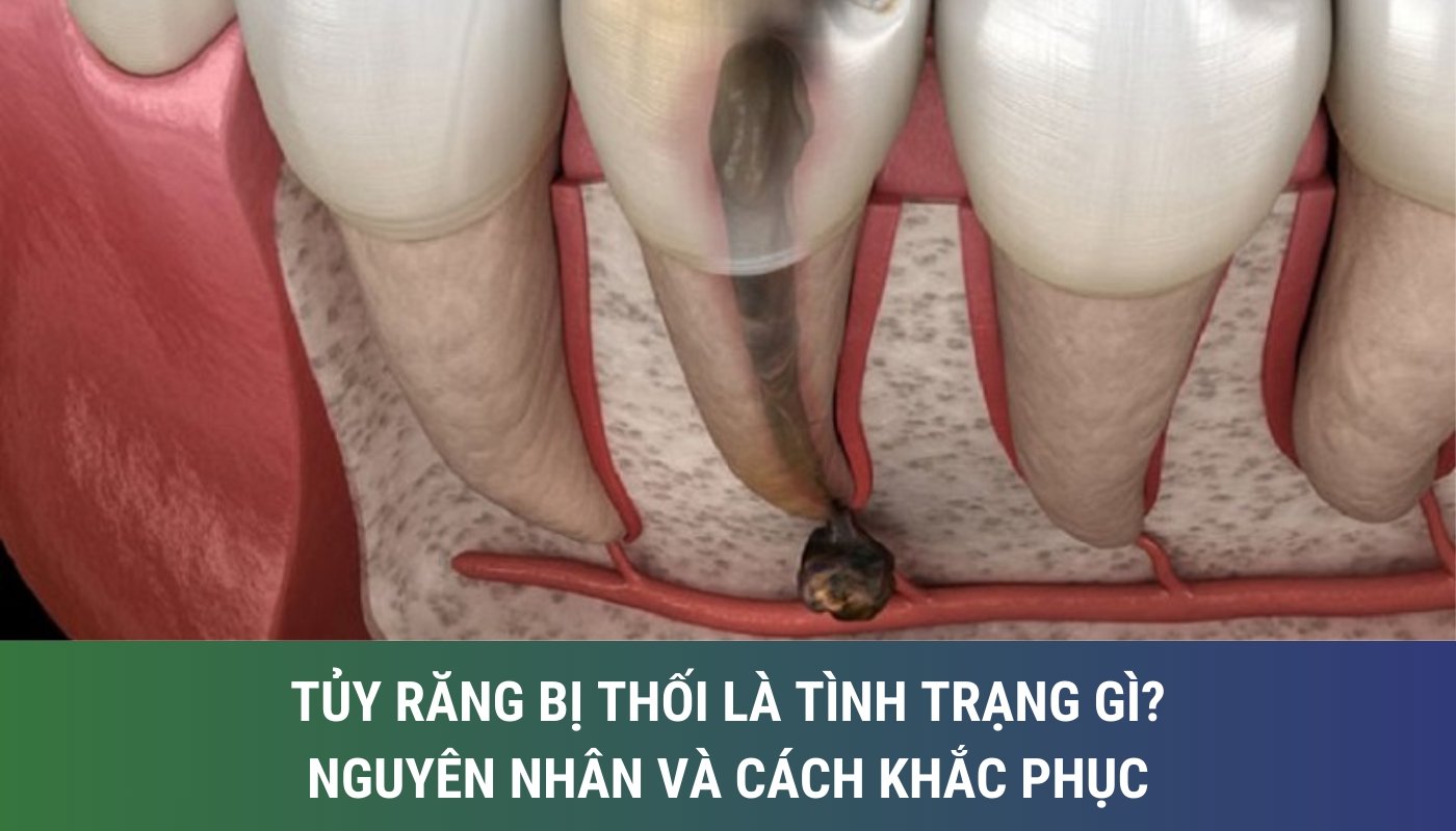 hình ảnh tủy răng bị thối và nguyên nhân