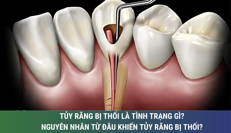 Tủy răng bị thối là tình trạng gì? Nguyên nhân khiến tủy răng bị thối