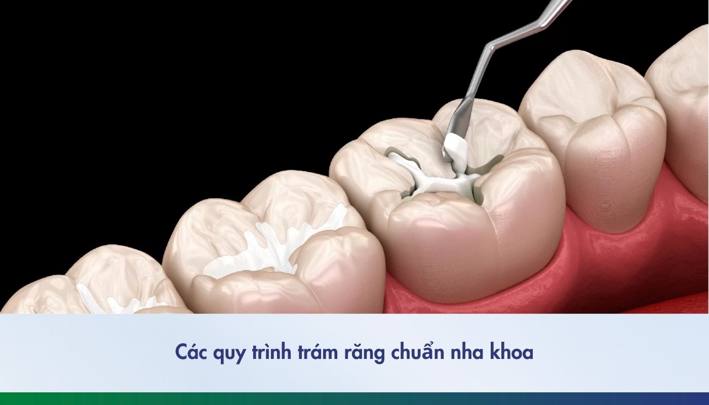 Tìm hiểu các quy trình trám răng chuẩn nha khoa hiện nay