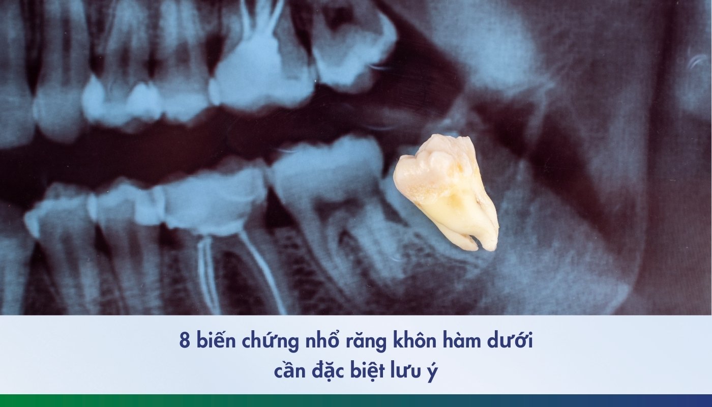 Biến chứng nhổ răng khôn hàm dưới cần lưu ý