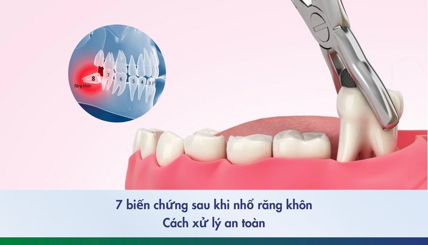 7 biến chứng sau khi nhổ răng khôn và cách xử lý an toàn