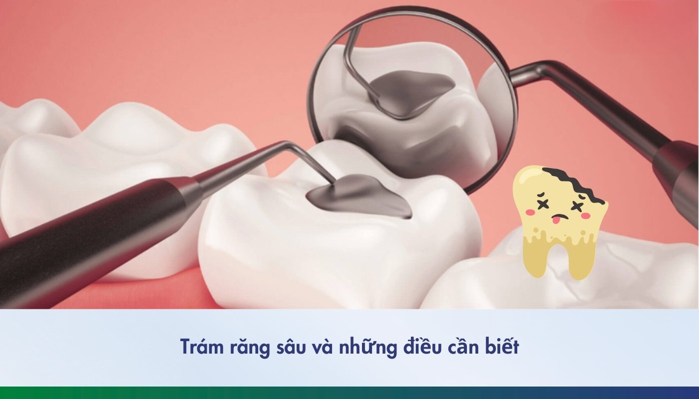 Trám răng sâu và những điều cần biết