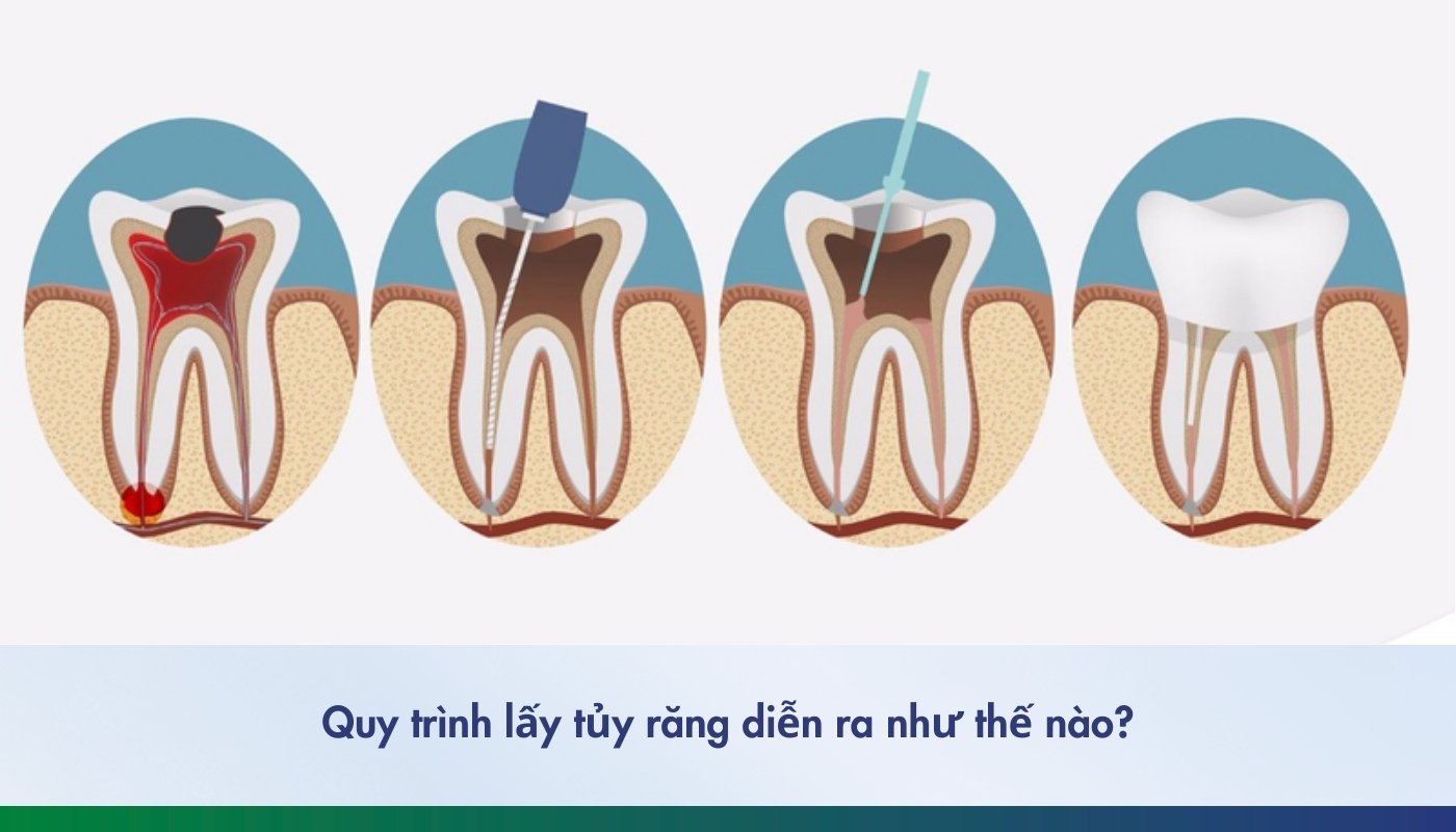 Quy trình lấy tủy răng như thế nào? Thời gian điều trị bao lâu?