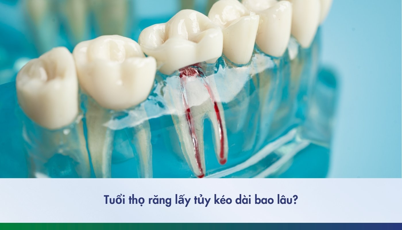 Tuổi thọ răng lấy tủy kéo dài bao lâu