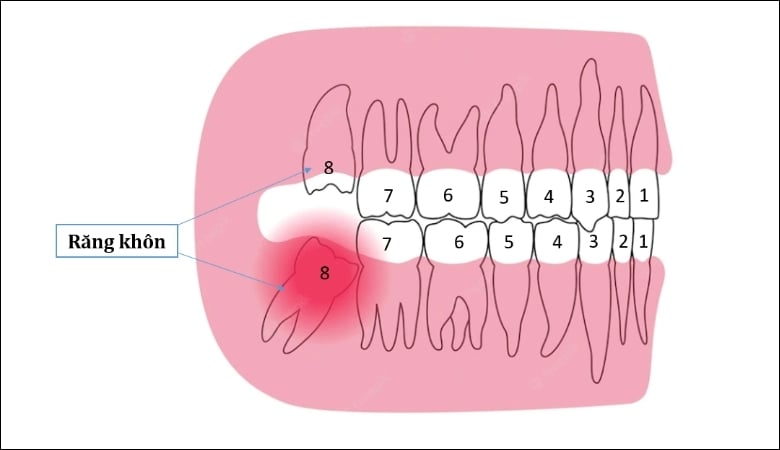 Biến chứng nhổ răng khôn hàm dưới - 8