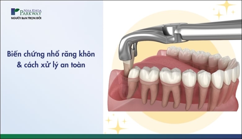 Biến chứng sau khi nhổ răng khôn - 1