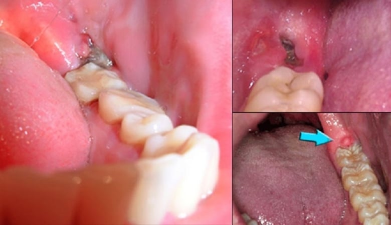 Biến chứng sau khi nhổ răng khôn - 6