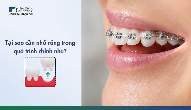 Các dạng nhổ răng chỉnh nha phổ biến - 1