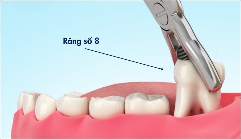 Các dạng nhổ răng chỉnh nha phổ biến - 6