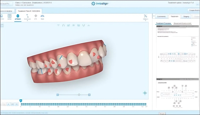 quy trình niềng răng invisalign - 6