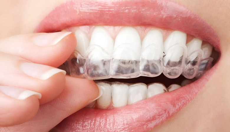 hình ảnh đeo khay niềng invisalign