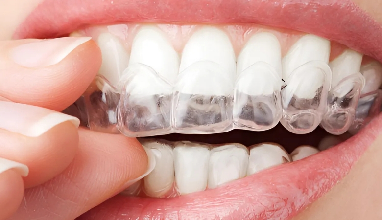 quy trình niềng răng invisalign - 8