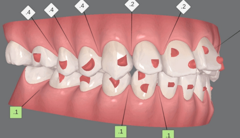 quy trình niềng răng invisalign - 7