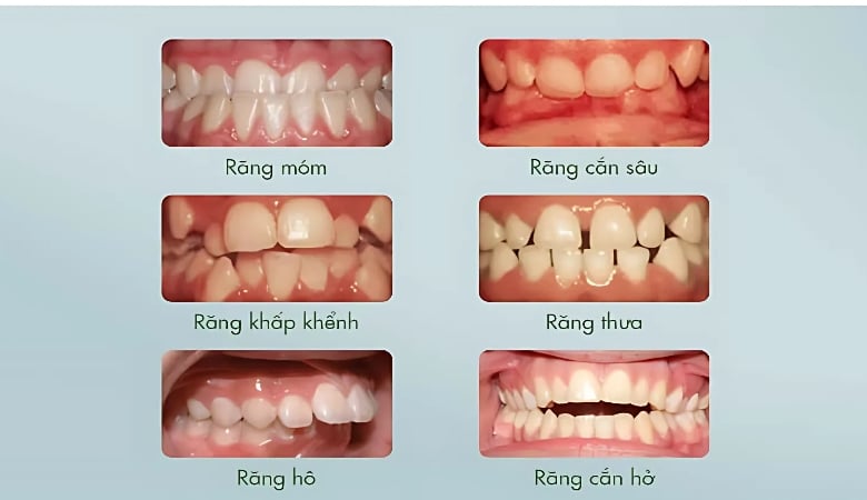 Những trường hợp cần niềng răng thẩm mỹ