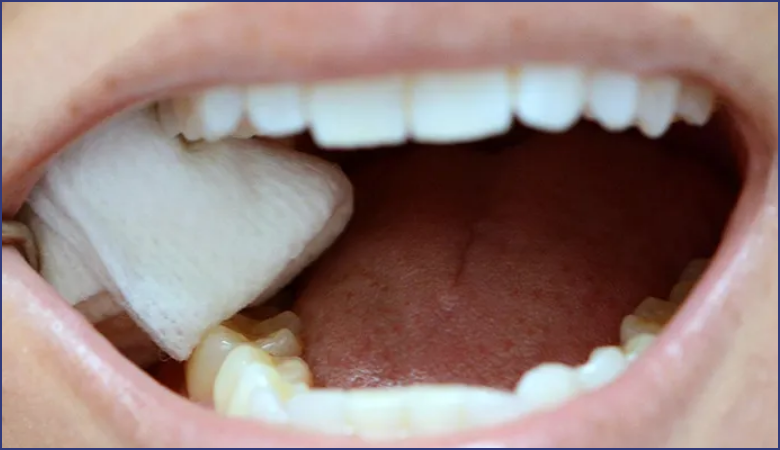 Kiểm soát chảy máu sau khi nhổ răng khôn