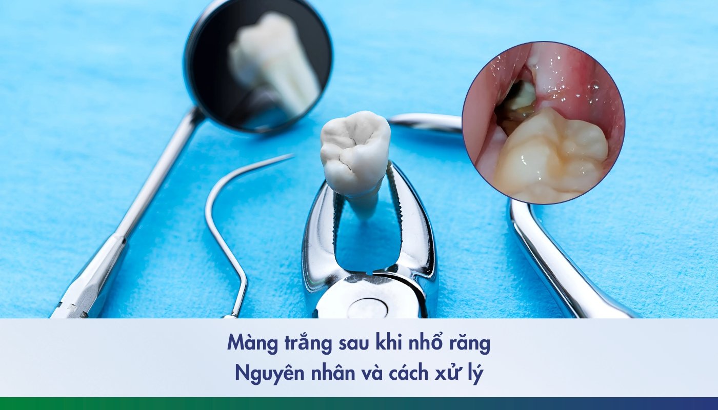 Màng trắng sau khi nhổ răng