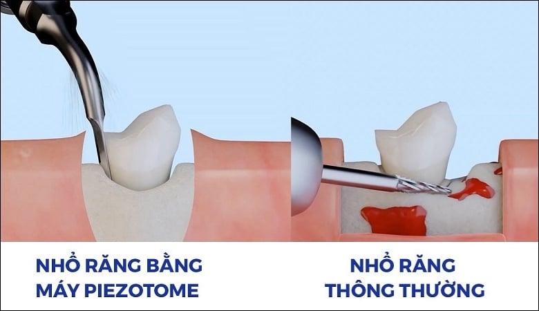 Cách nhổ răng không đau - 6