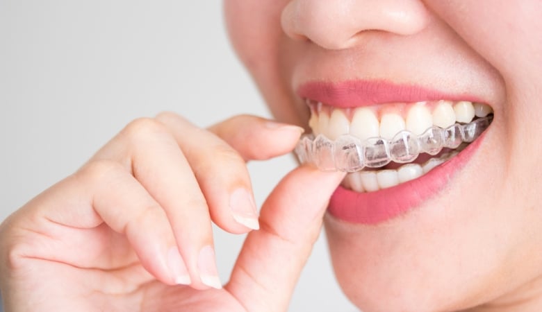 Lưu ý khi niềng răng Invisalign - 2