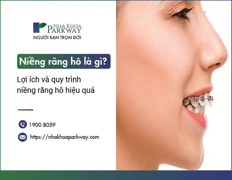 Niềng răng hô là gì? Lợi ích và quy trình các bước niềng răng hô hiệu quả