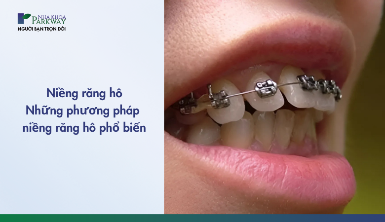 niềng răng hô và các phương pháp niềng răng phổ biến