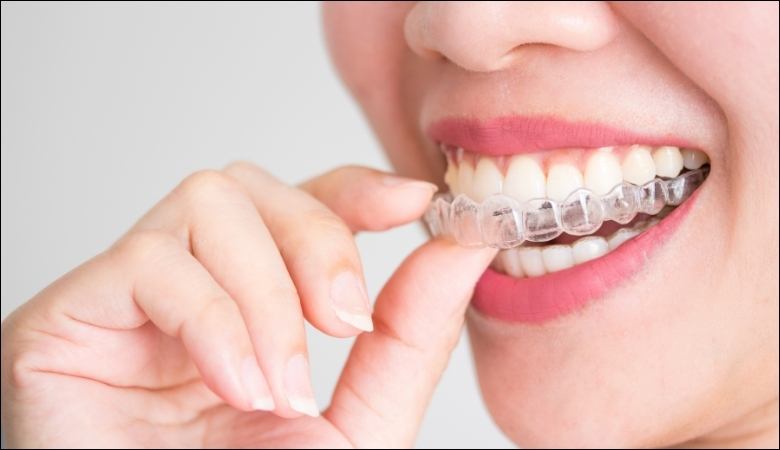 Niềng răng Invisalign - 4