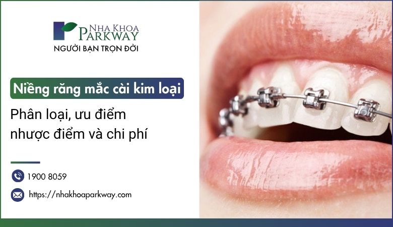 Niềng răng mắc cài kim loại là gì? Phân loại, ưu nhược điểm và chi phí