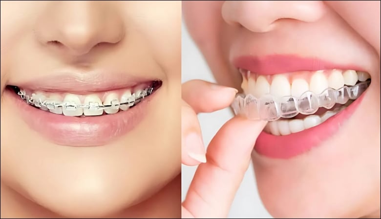 Niềng răng invisalign và mắc cài