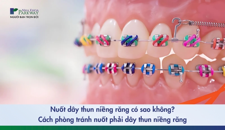 nuốt thun niềng răng có sao không