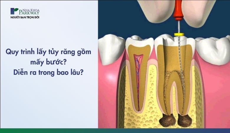 Quy trình lấy tủy răng như thế nào - 1