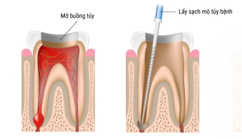 Quy trình lấy tủy răng như thế nào - 6