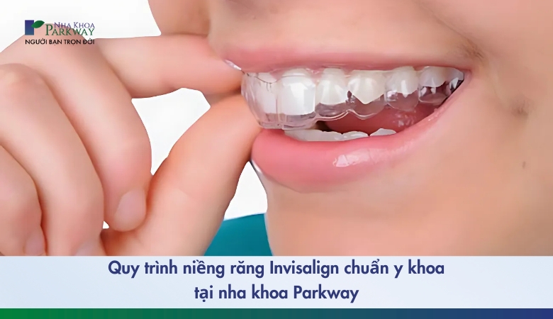 quy trình niềng răng invisalign - 1