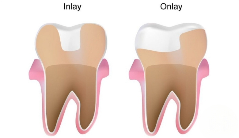 Quy trình trám răng chuẩn nha khoa - 4