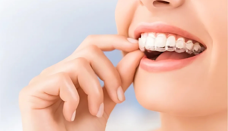 hình ảnh tháo khay niềng invisalign