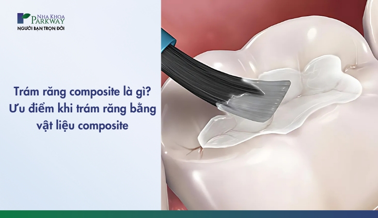 trám răng composite là gì và những ưu điểm