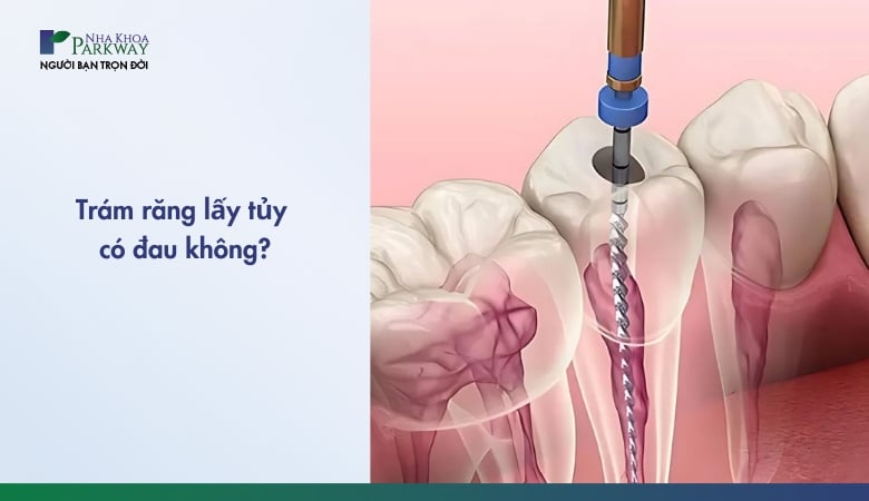 trám răng lấy tủy có đau không