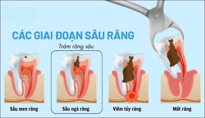 Trám răng sâu - 9