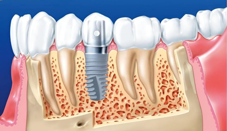 hình ảnh cấy ghép implant