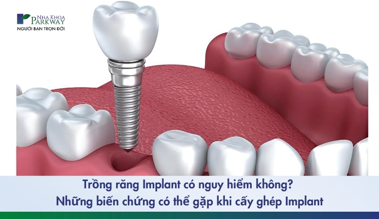 trồng răng Implant có nguy hiểm không 