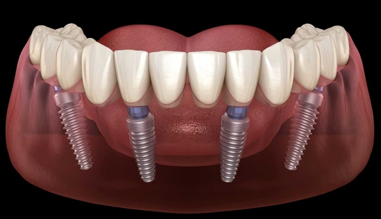 Trụ Implant Hàn Quốc - 5